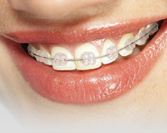 Invisalign