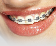 Invisalign