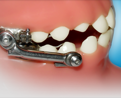 Invisalign