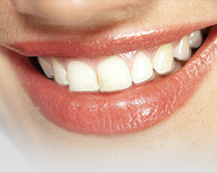 Invisalign